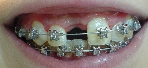 Реставрация зуба с помощью Glasspan. До лечения